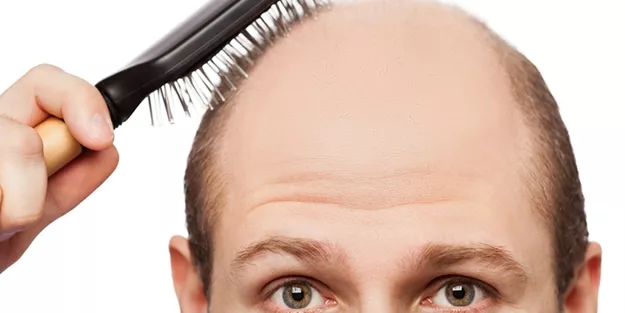 Was für Formen des Haarausfalls gibt es